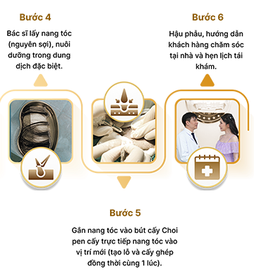 Cấy tóc việt nam