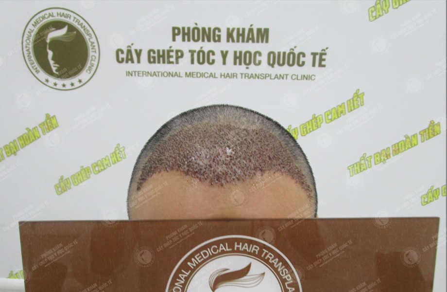 Lê Đình Phong - Cấy tóc đường chữ M 4