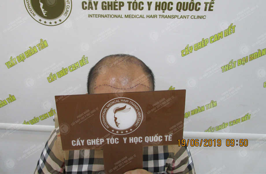 Bùi Duy Trung - Cấy tóc tự thân 2