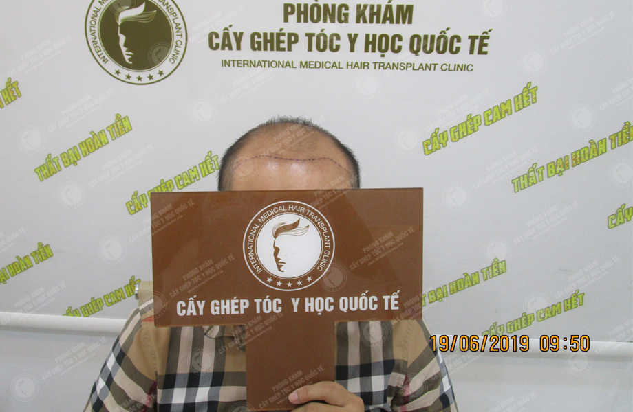 Bùi Duy Trung - Cấy tóc tự thân 3