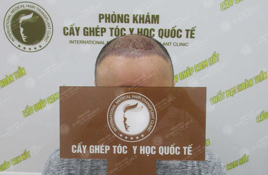 Ngô Gia Huy - Cấy tóc tự thân 5