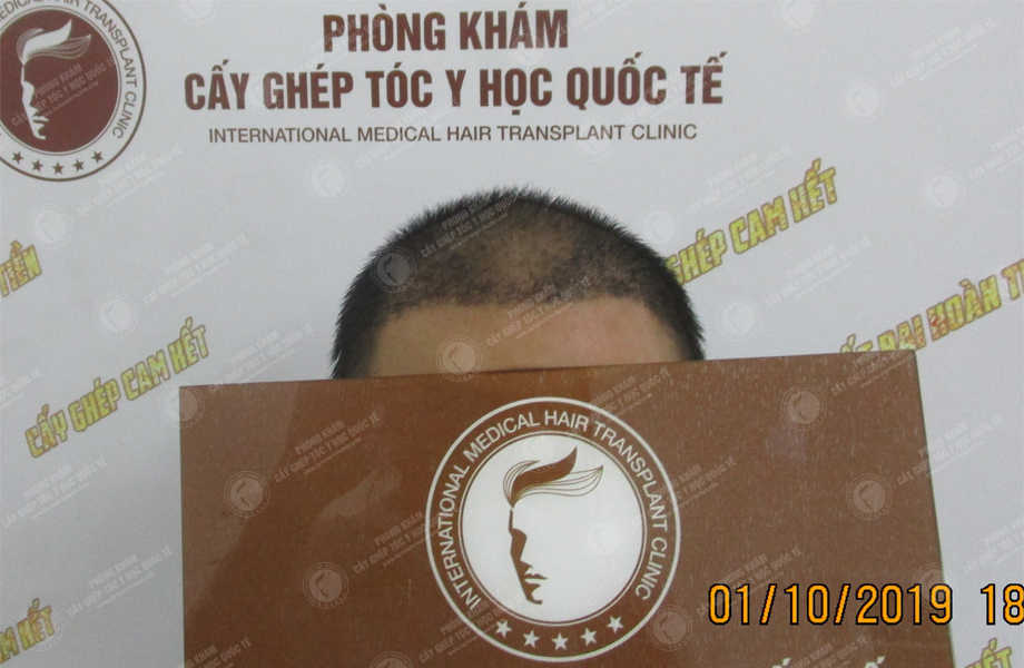 Lê Hữu Quỳnh - Cấy tóc đường chữ M 8