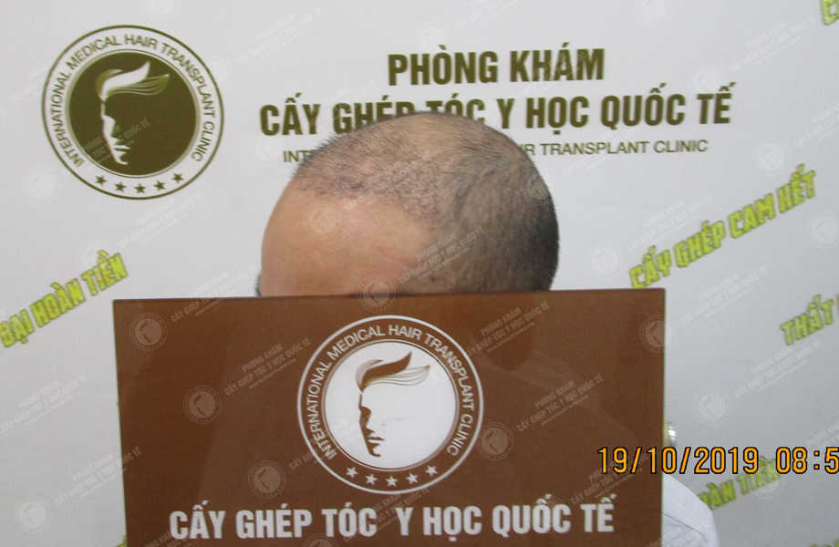 Lý Văn Nam - Cấy tóc tự thân 8