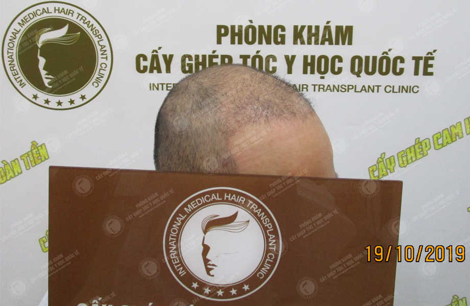 Lý Văn Nam - Cấy tóc tự thân 9