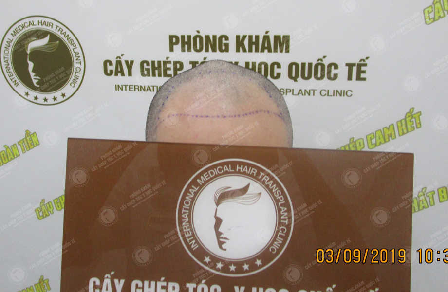 Nguyễn Quang Nam - Cấy tóc tự thân 3