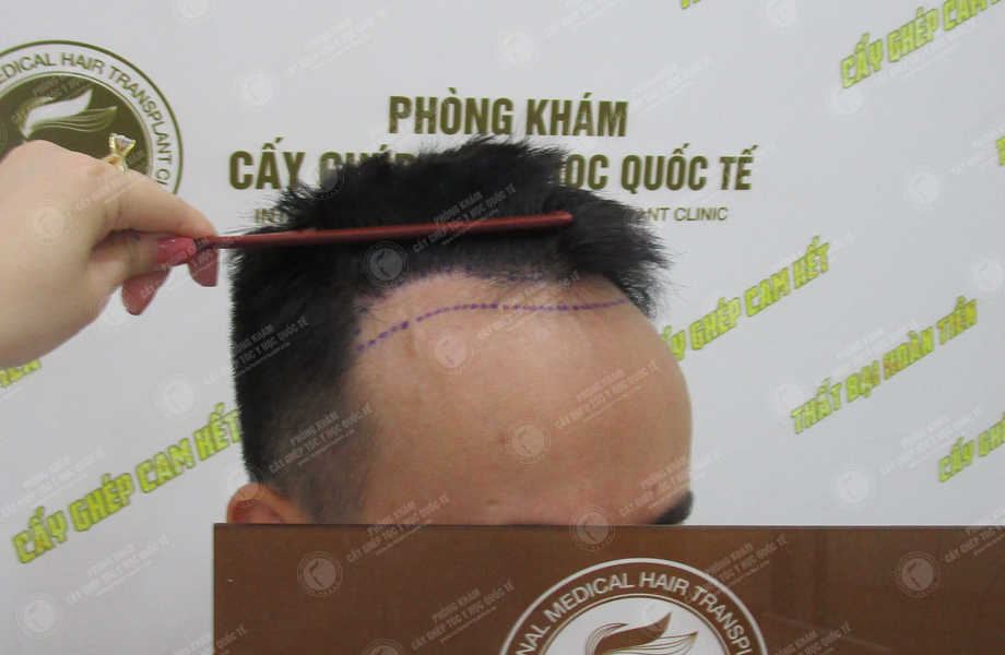 Phạm Văn Phi - Cấy tóc tự thân 2