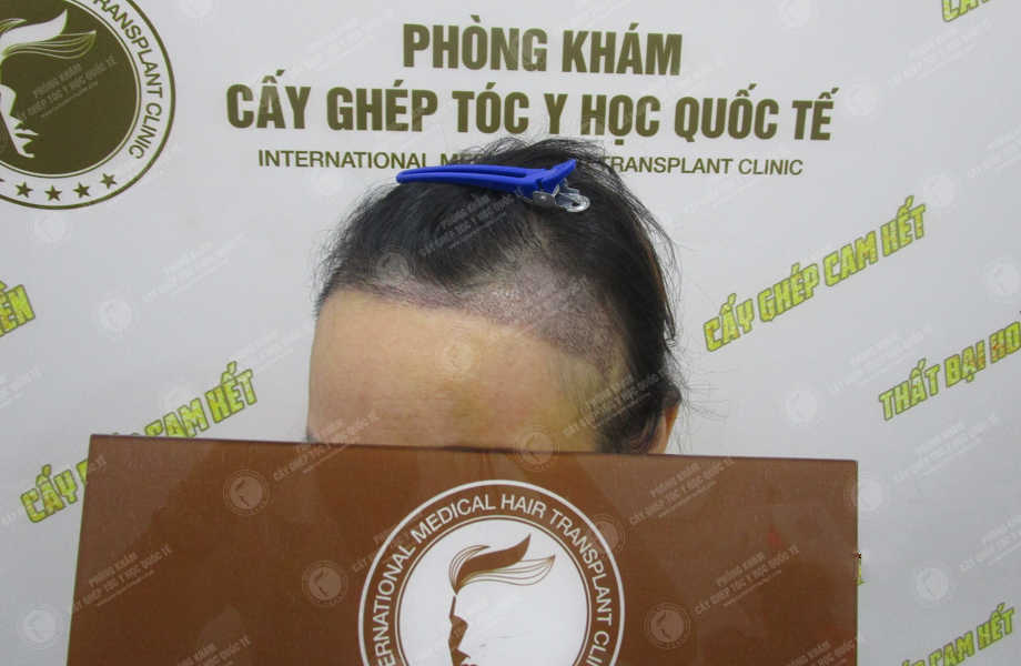 Trần Phương Ly - Cấy tóc tự thân 11