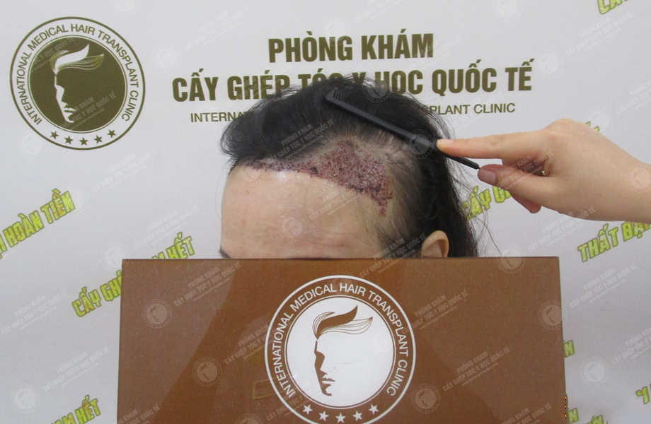 Trần Phương Ly - Cấy tóc tự thân 4