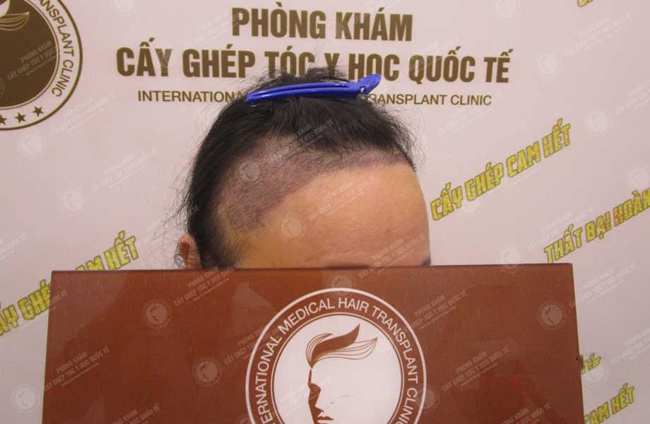 Trần Phương Ly - Cấy tóc tự thân 10