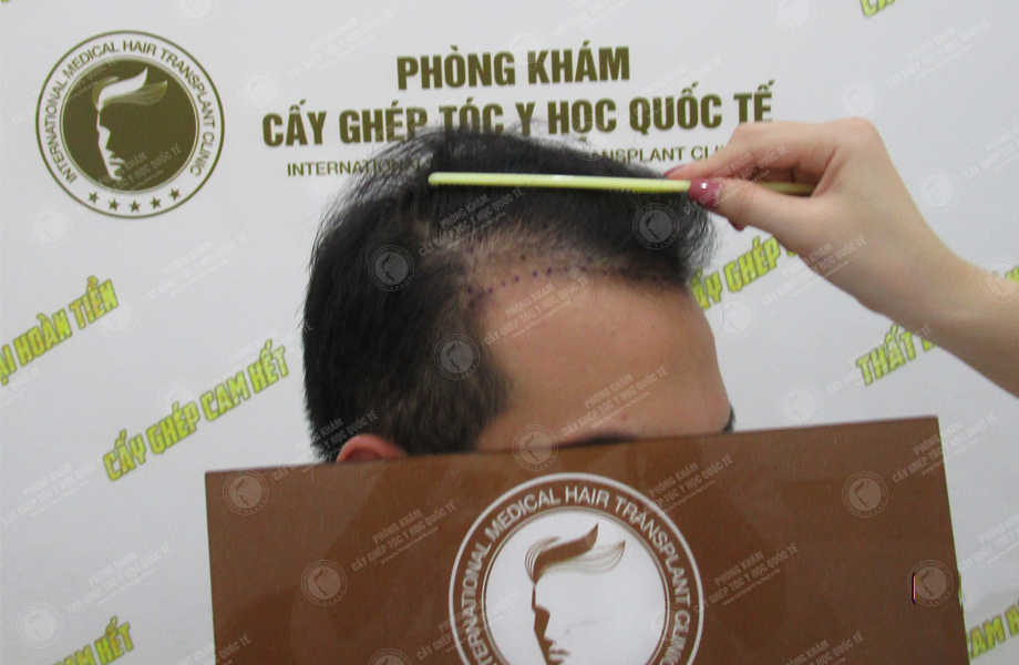 Hoàng Văn Hiển - Cấy tóc tự thân 2