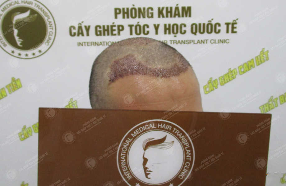 Hoàng Văn Hiển - Cấy tóc tự thân 4