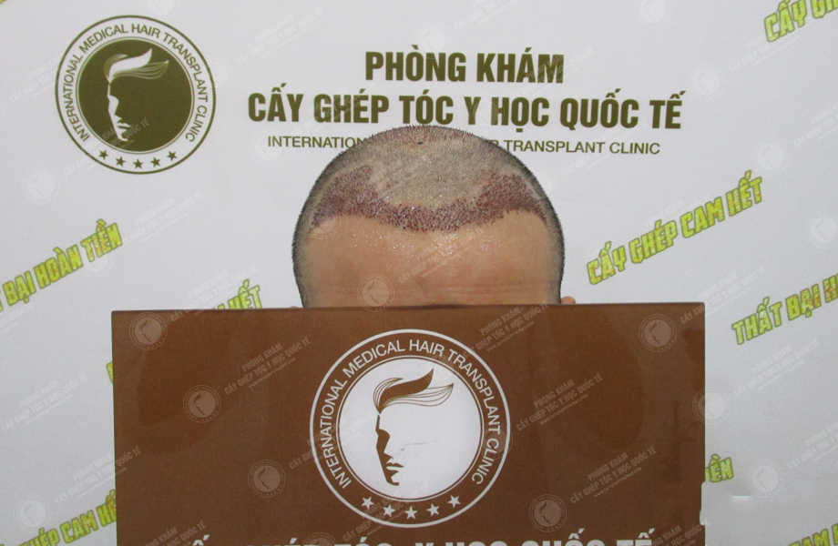 Hoàng Văn Hiển - Cấy tóc tự thân 5