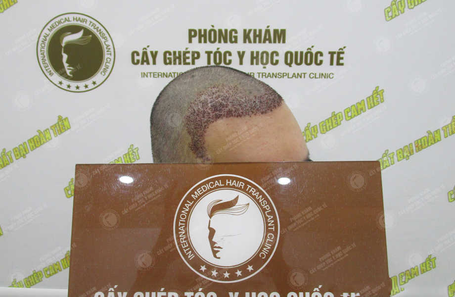 Trần Quốc Trọng - Cấy tóc tự thân 7