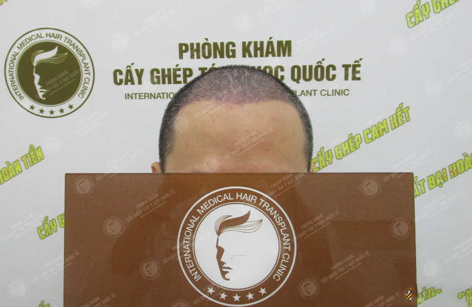 Hoàng Bảo Minh - Cấy tóc tự thân 7