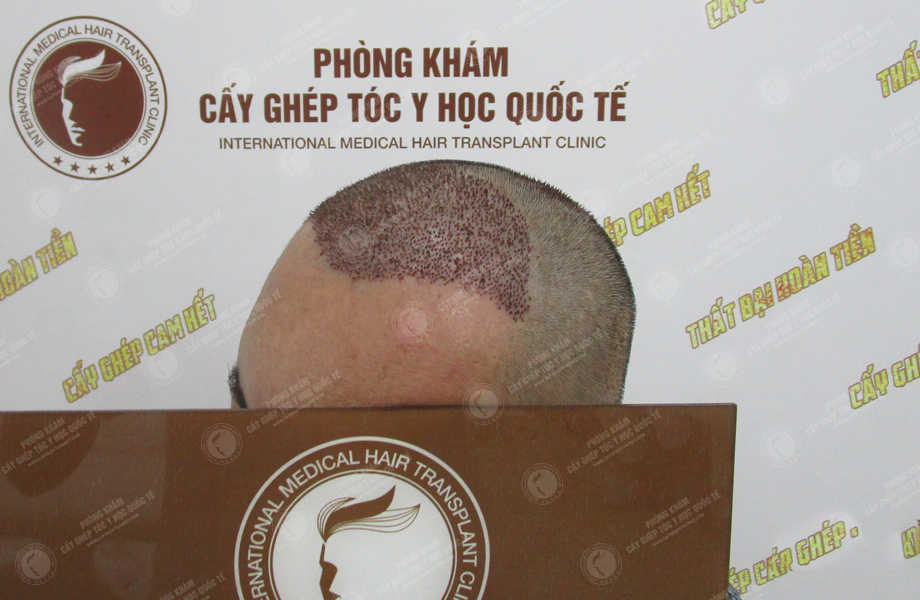 Phạm Ngọc Tùng - Cấy tóc tự thân 4