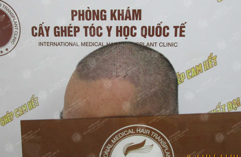 Phạm Ngọc Tùng - Cấy tóc tự thân 6