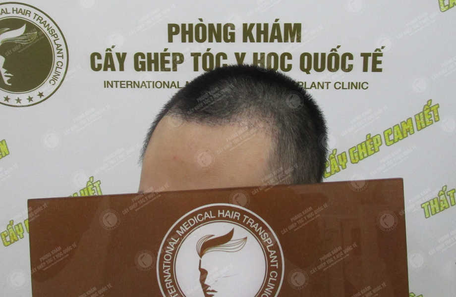 Trần Mạnh Đoàn - Cấy tóc đường chữ M 9