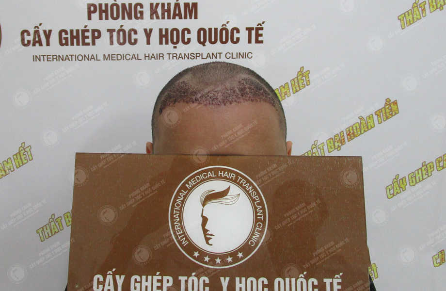 Hoàng Thanh Bình - Cấy tóc tự thân 6