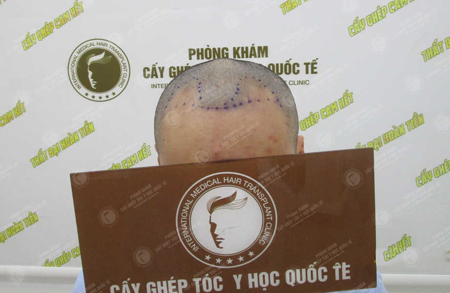 Trần Bình Trọng - Cấy tóc tự thân 3