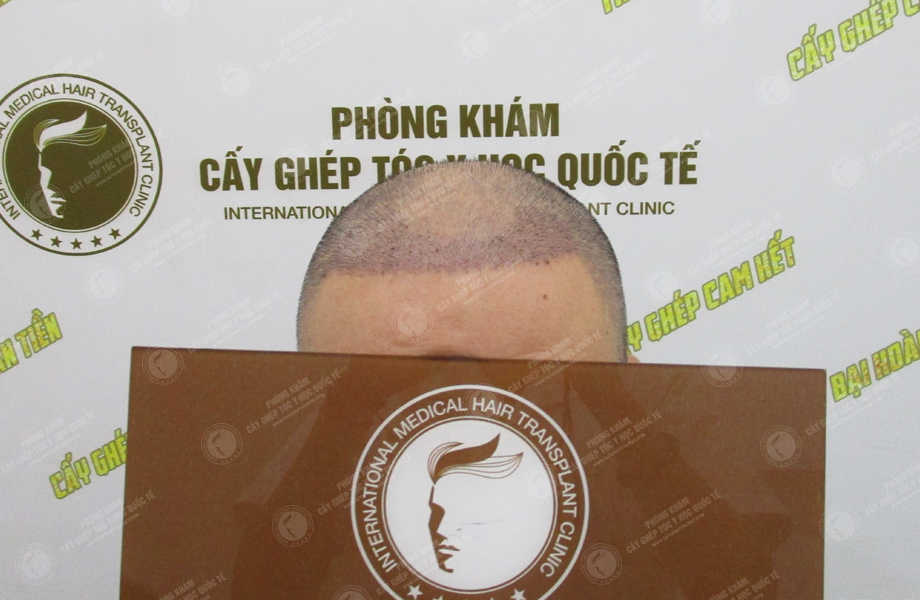 Trần Khánh Toàn - Cấy tóc tự thân 7