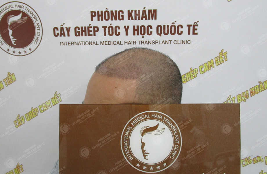 Trần Khánh Toàn - Cấy tóc tự thân 8