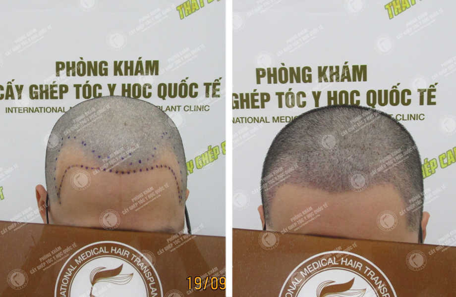  Trần Khánh Hưng - Cấy tóc tự thân 1