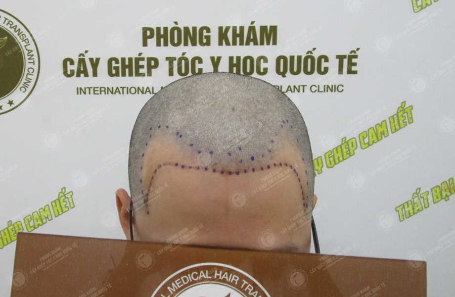 Trần Khánh Hưng - Cấy tóc tự thân 4