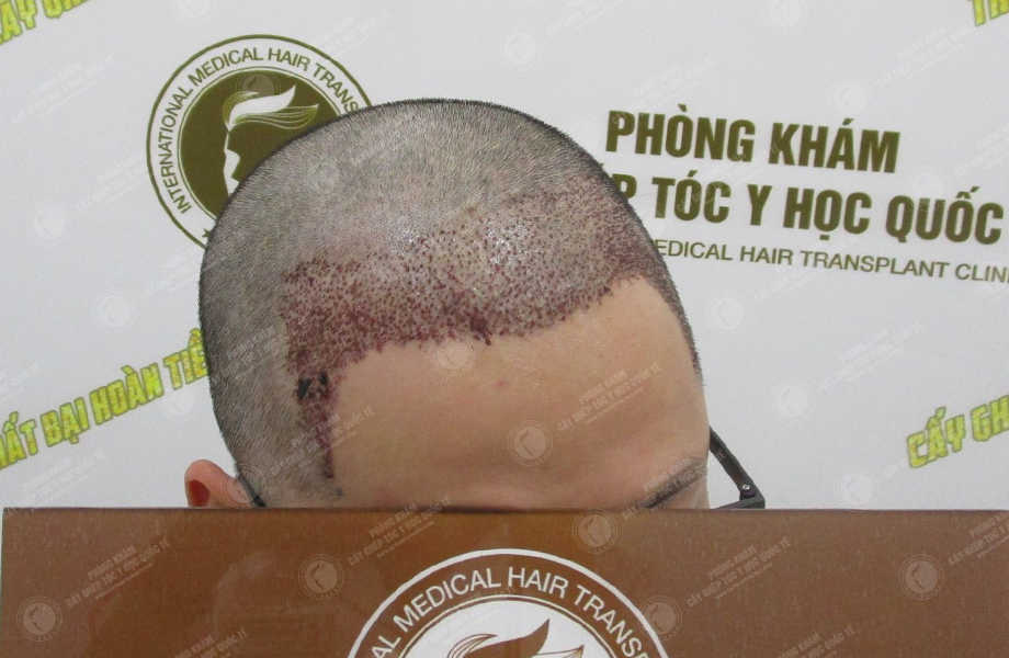 Trần Khánh Hưng - Cấy tóc tự thân 7