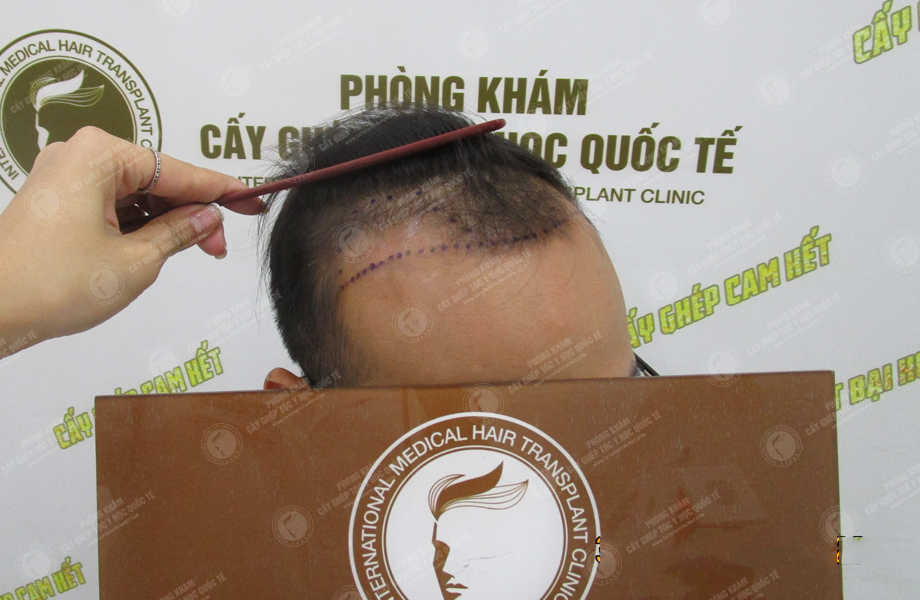 LÝ THANH SƠN - Cấy tóc tự thân 2