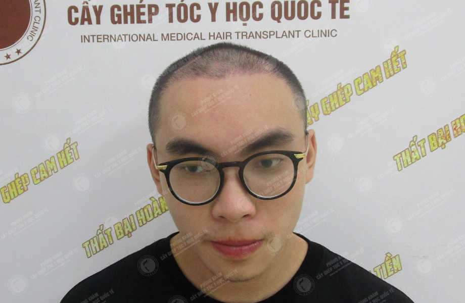 Trần Quang Hiệp (ProE) - Cấy tóc tự thân 9