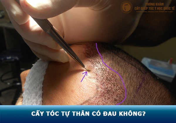 cấy tóc có đau không