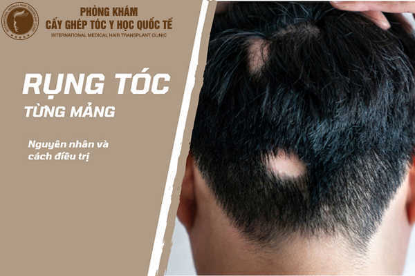 Kinh nghiệm chữa rụng tóc từng mảng hiệu quả tức thì