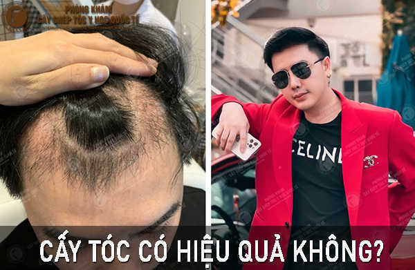 Cấy tóc tự thân có hiệu quả không? Giải đáp từ chuyên gia