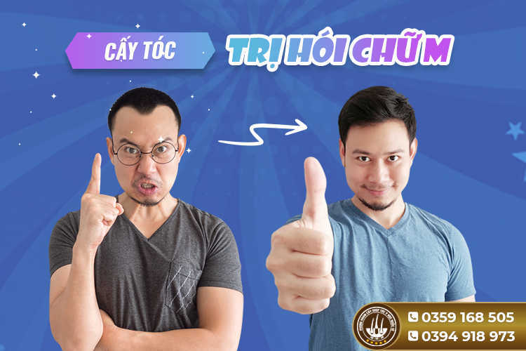 Cấy tóc trị hói chữ M [ Quy trình – chi phí – địa chỉ uy tín]