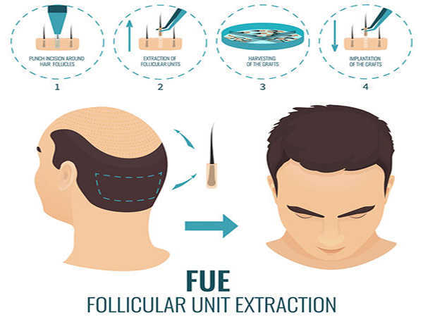 Cấy tóc FUE – Giải pháp làm đẹp hiện đại cho người hói đầu, tóc thưa, rụng tóc nhiều