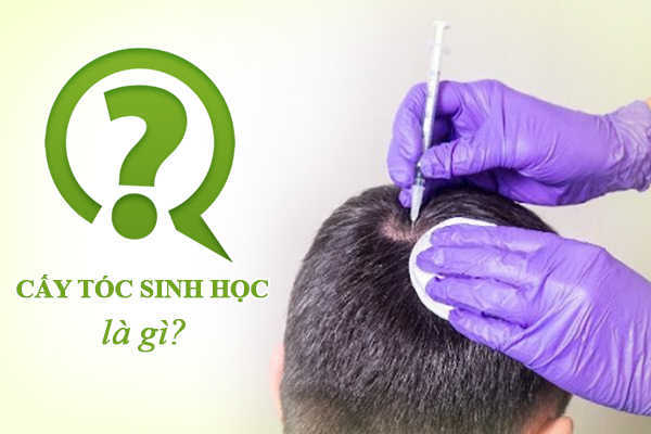 Bác sĩ chia sẻ cấy tóc sinh học là gì? Tổng quan cấy tóc sinh học