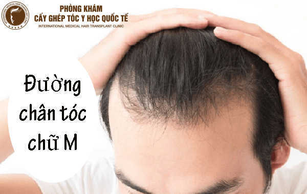 Tìm hiểu về phương pháp cấy tóc đường chữ M