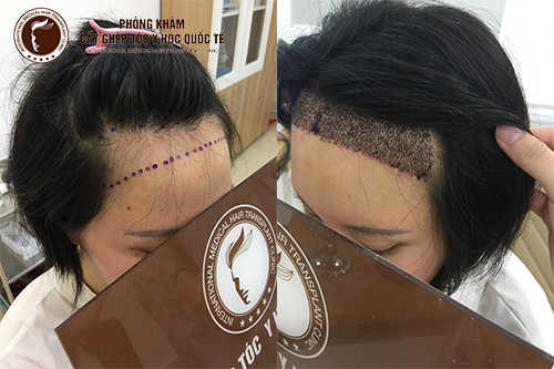Phẫu thuật hạ đường viền tóc tại Hàn Quốc | phẫu thuật gọt mặ 【ID Hospital】