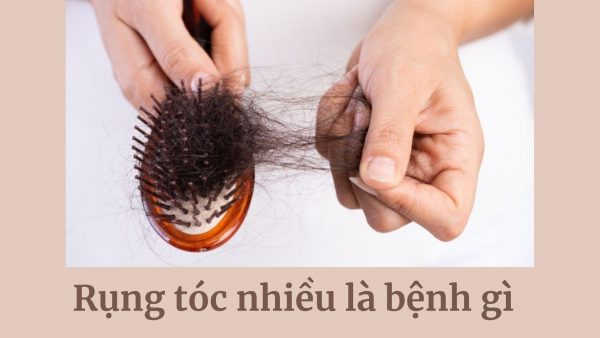 Rụng tóc nhiều là bệnh gì? Có phải do ung thư không?