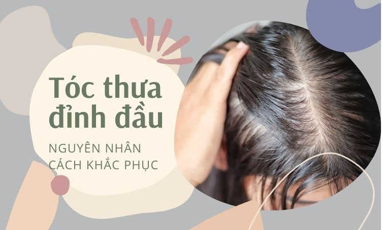 Điểm mặt 10+ nguyên nhân gây tóc thưa ở đỉnh đầu nam thường gặp