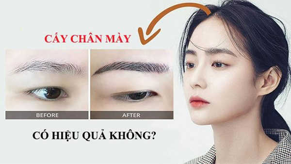 Cấy lông mày tự thân có thật sự tốt như quảng cáo?