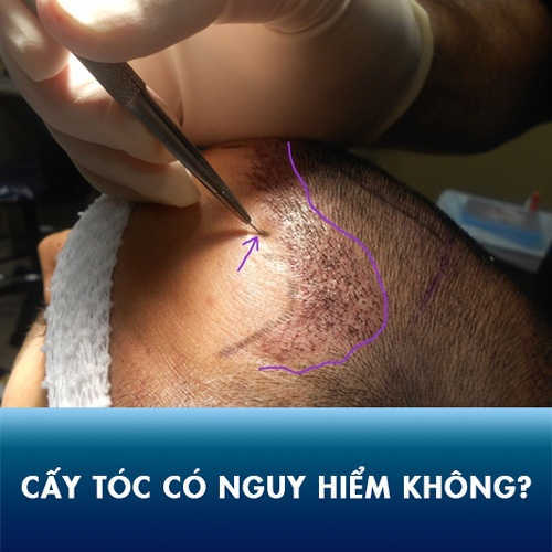 Cấy tóc có nguy hiểm không? Địa chỉ cấy tóc an toàn – hiệu quả