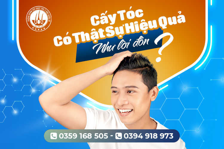 Cấy tóc có thực sự hiệu quả như lời đồn?