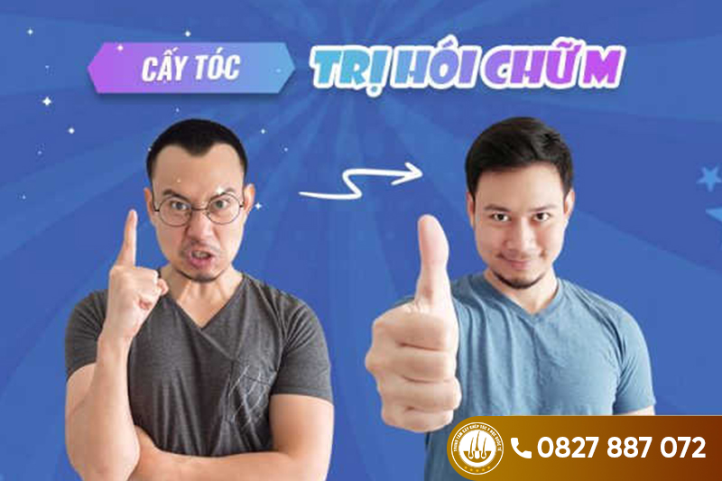 Cấy tóc – Giải pháp hữu hiệu  cho đàn ông bị hói 2 bên trán