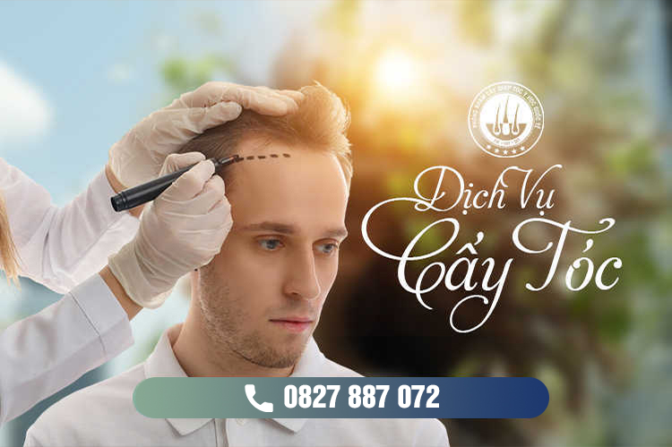 Dịch vụ cấy tóc và những điều quan trọng cần biết