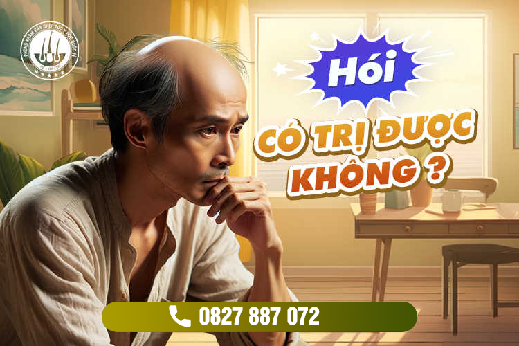 Hói có trị được không? Phương pháp chữa hói tự thân nhiều người tin tưởng điều trị