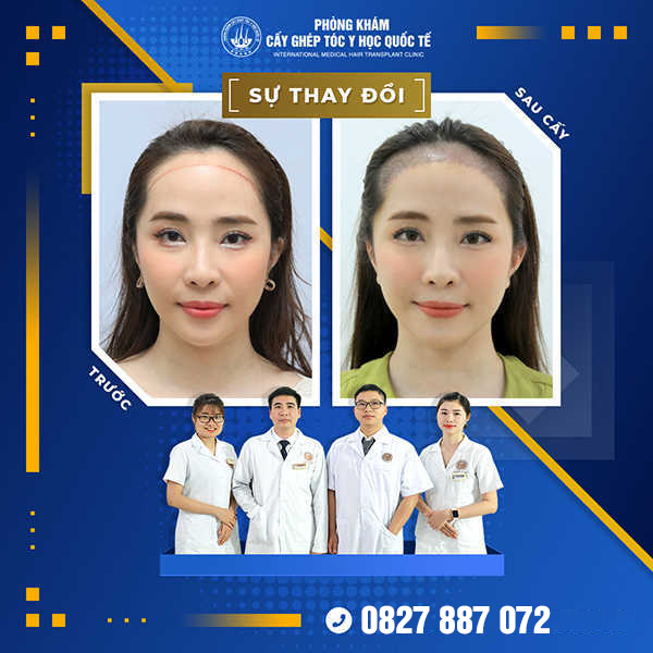 Diễn Viên Quỳnh Nga: “ Cấy tóc tự thân giúp tôi nâng tầm nhan sắc”