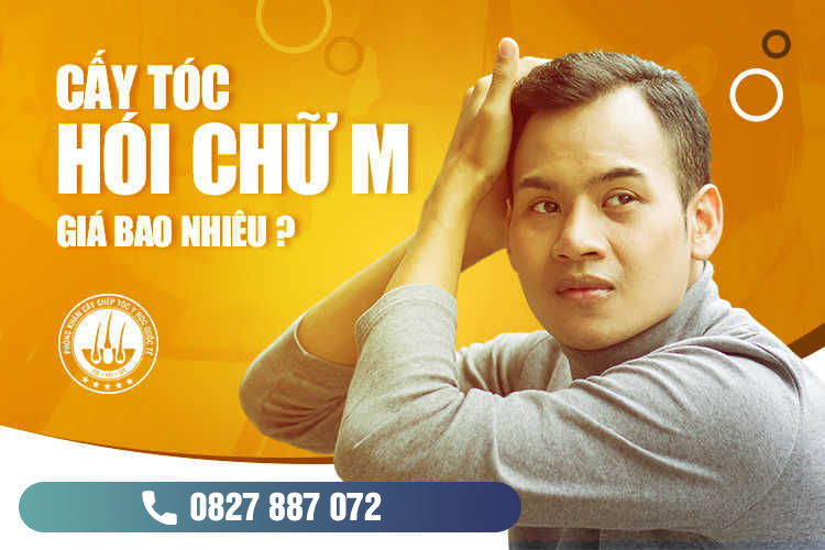 Cấy tóc hói chữ M giá bao nhiêu? Có đắt không?