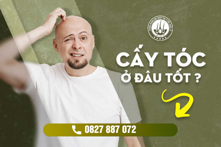 Cấy tóc trị hói chữ M [ Quy trình – chi phí – địa chỉ uy tín]