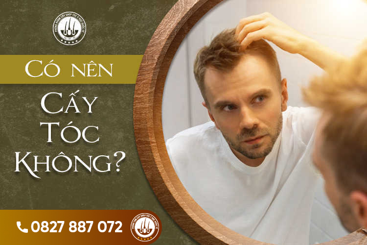 Có nên cấy tóc không? Địa chỉ cấy tóc đáng tin cậy
